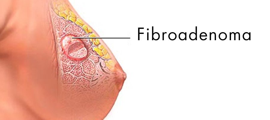 Ilustração que mostra o fibroadenoma no seio de uma mulher