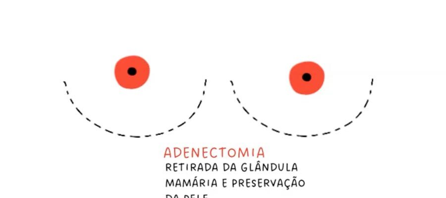 Ilustração de seios explicando adenectomia