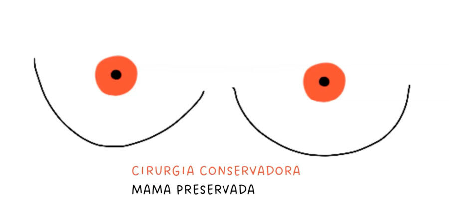 Ilustração de seios e a frase 'cirurgia conservadora mama preservada'