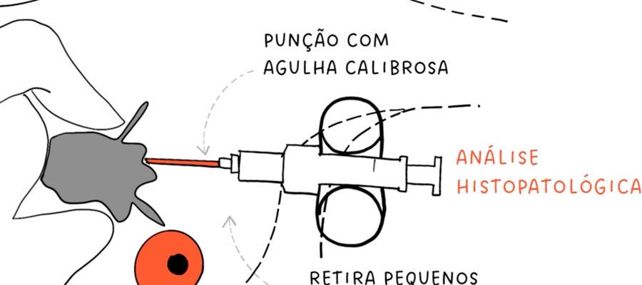 Ilustração sobre Core Biopy e Mamotomia