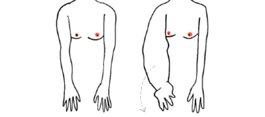 Ilustração do corpo de duas mulheres, uma com linfedema e outra, sem linfedema