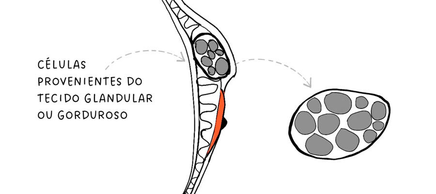 Ilustração de como se formam os nódulos