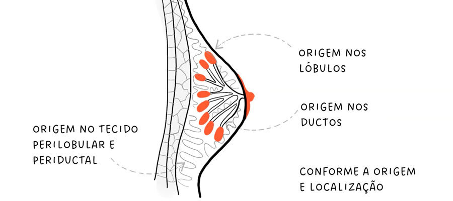 Ilustração dos tipos de tumores na mama